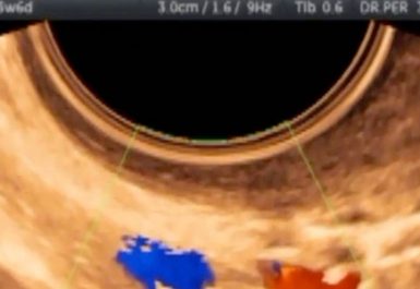 Eco Doppler color
