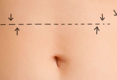 Abdominoplastia